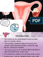 Ovarian Cyst Types, Symptoms, Diagnosis & Treatment