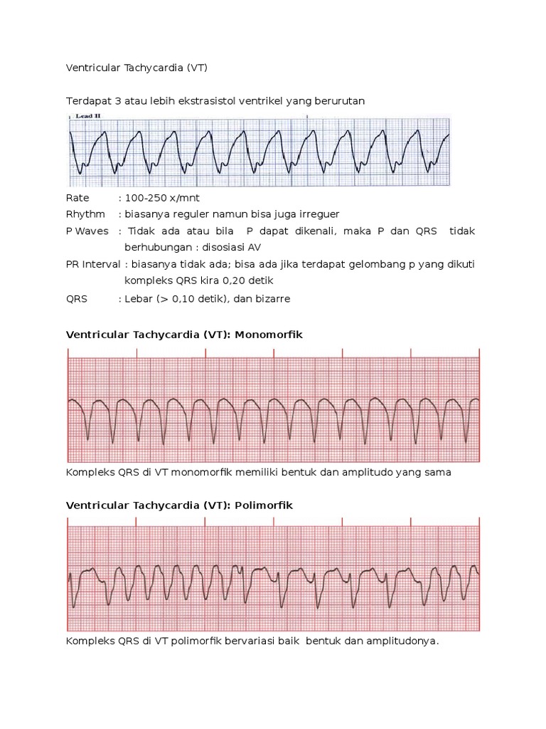 Ventricular Tachycardia Vt Monomorfik Pdf