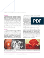 Lumbar Hernia: Case Report