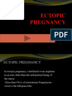 Ectopic Pregnancy: Understanding Causes, Symptoms and Treatment