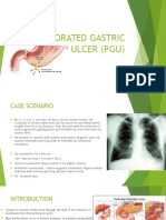 Perforated Gastric Ulcer (Pgu)
