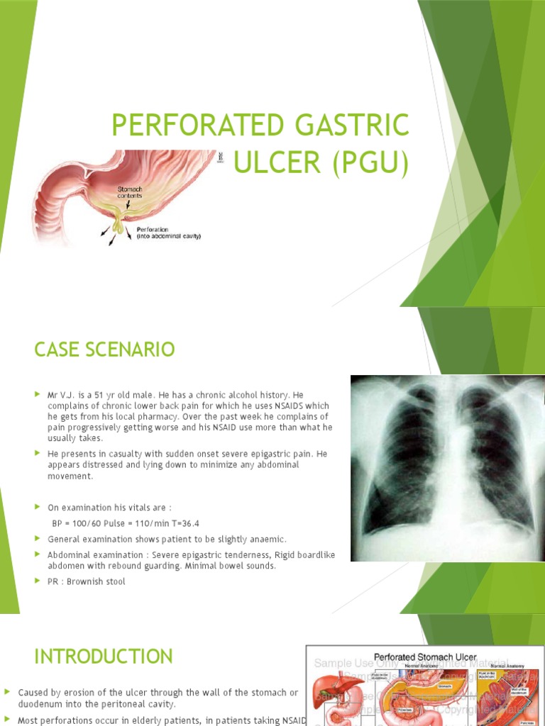 Perforated Gastric Ulcer (Pgu) Peptic Ulcer Clinical Medicine