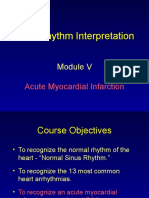 ECG Rhythm Interpretation: Acute Myocardial Infarction