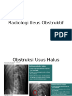 Radiologi Ileus Obstruktif