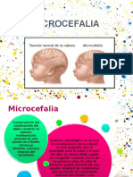 Microencefalia