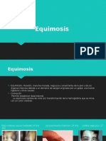 Equimosis