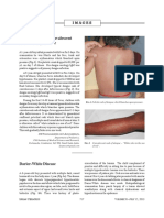 Febrile Rash and Convalescent Rash of Dengue Fever: Images Images Images Images Images