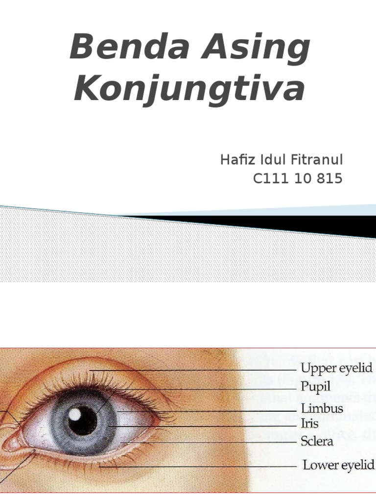 Benda Asing Konjungtiva