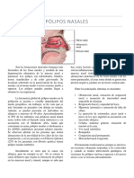 Pólipos Nasales PDF