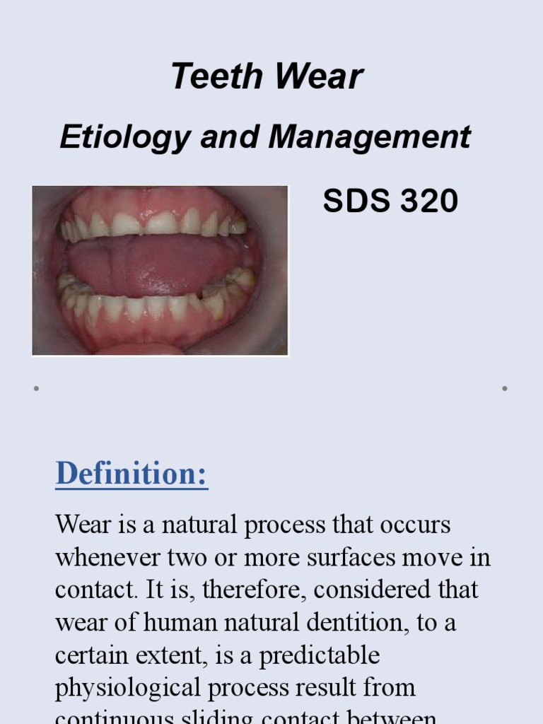 Tooth Wear PDF
