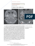 Internal Carotid Middle Ear