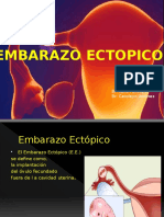 Embarazo Ectopico