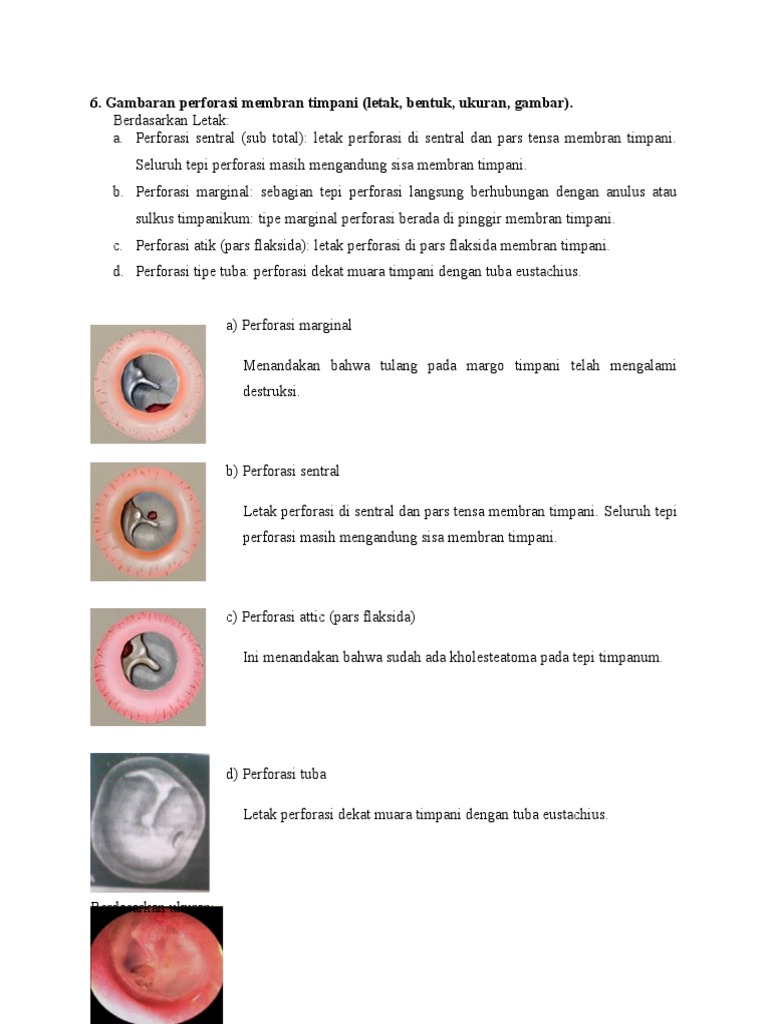 perforasi membran timpani,kuman peyebab dan cara penatalaksanaan