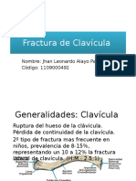 Fractura de Clavicula