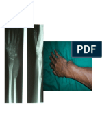 Giant Cell Tumor of The Distal Ulna