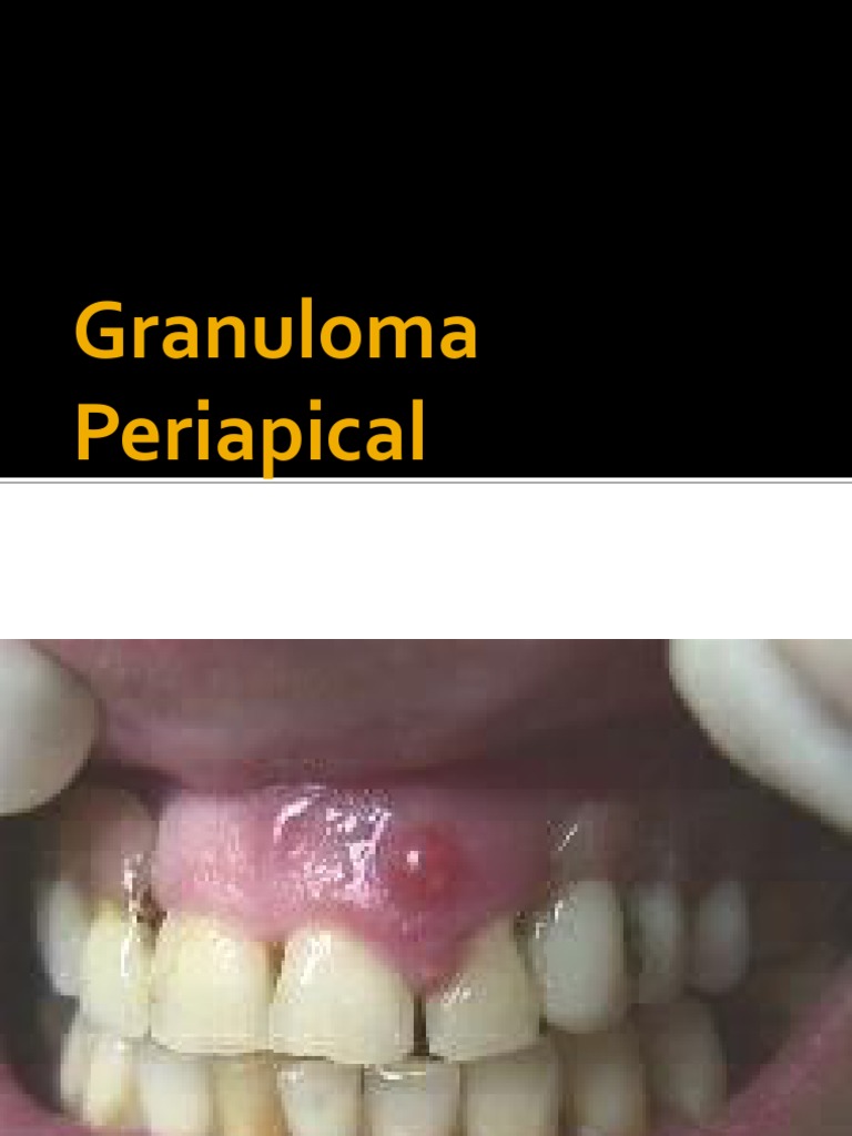 Granuloma Periapical | PDF