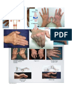 Deformacion Artritis reumatoide