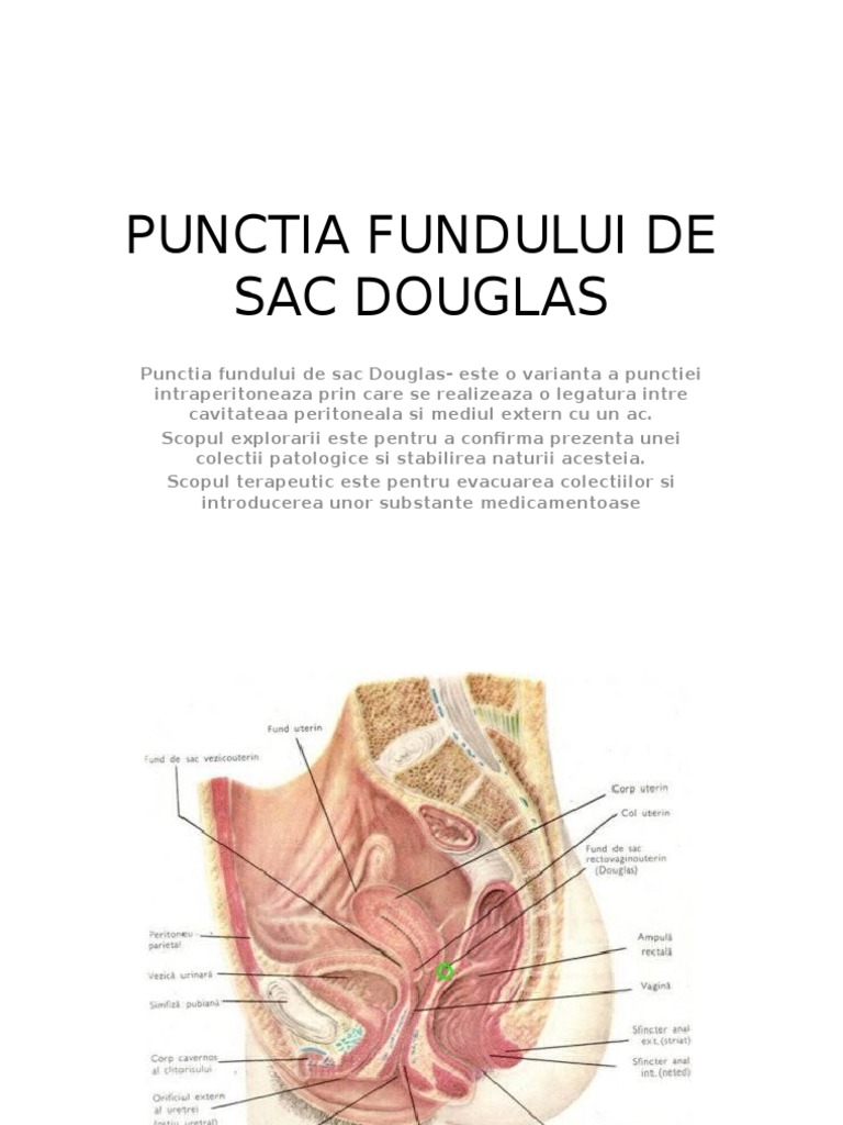 Punctia Fundului de Sac Douglas | PDF