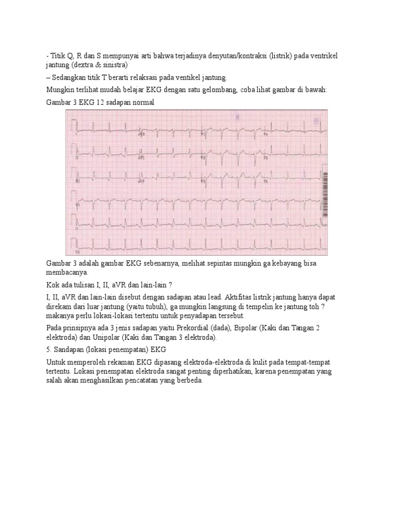 Unduh 91 Gambar Gelombang Ekg Normal  