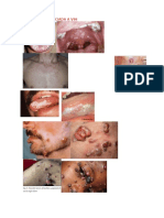 Dermatosis Infecciosas Asociada a Vih