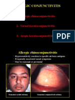 Allergic Conjunctivitis: 1. Allergic Rhinoconjunctivitis 2. Vernal Keratoconjunctivitis