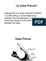 Vasa Previa - Antenatal Hemorrhage, Pregnancy