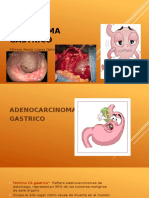 Carcinoma Gastrico