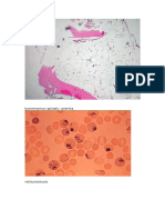 Bonemarrow Aplastic Anemia