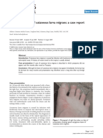 Late Presentation of Cutaneous Larva Migrans: A Case Report: Michael Archer