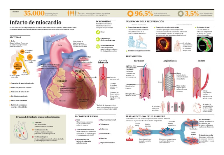 2012 - Infarto de Miocardio PDF | PDF | Infarto de miocardio | Músculo ...