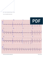 I aVR V1 V4: Case #449