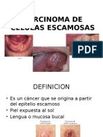 Carcinoma de Celulas Escamosas