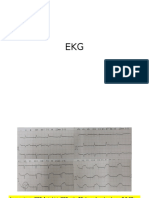 Ekg