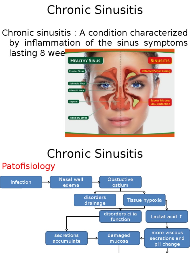 Chronic Sinusitis Guide Pdf