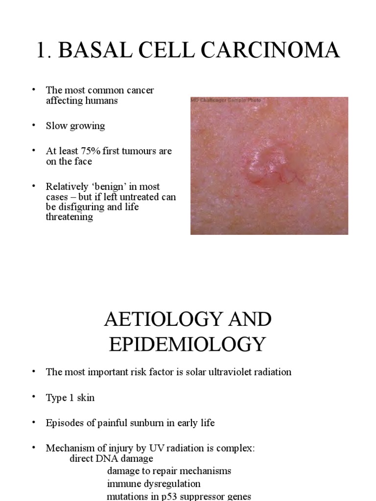 BASAL CELL CARCINOMA.ppt Medical Specialties Neoplasms