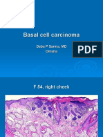  Basal Cell Carcinoma .  