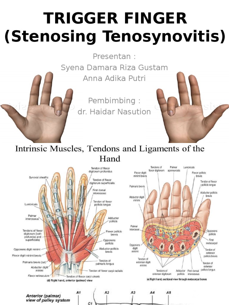 Trigger finger pdf