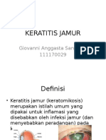 Keratitis Jamur