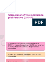 Glomerulonefritis Membrano-Ploliferativa (GNMP)