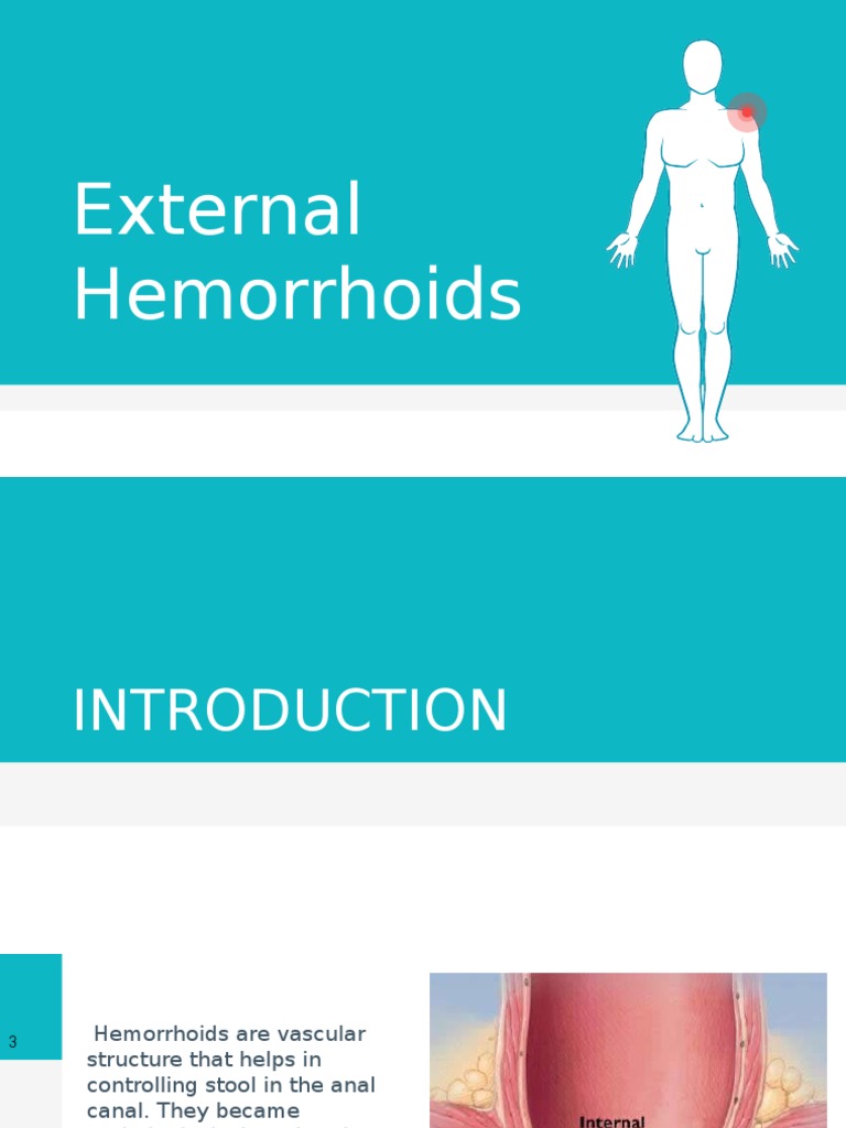 External Hemorrhoids Hemorrhoid Health Sciences