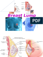 Breast Lump