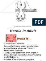 Hernia Adult