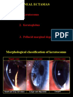 Types of Corneal Ectasias: Keratoconus, Keratoglobus, Pellucid Marginal Degeneration