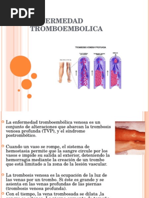 Tratamiento De Trombosis Venosa Profunda En Terneros Insuficiencia Renal E Hipertension Arterial Pdf