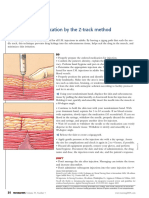 Z-Tract Method of Ims