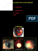 Abnormal Lens Shape Conditions: Coloboma, Lenticonus & Small Lens
