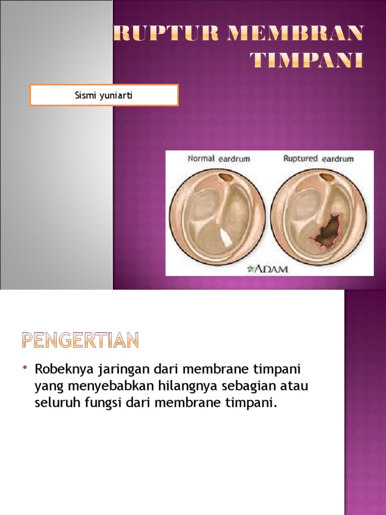Ruptur Membran Timpani PDF
