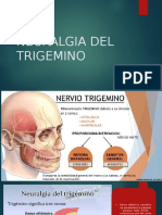 Neuralgia Del Trigemino