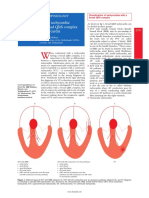 Ventricular Tachycardia - Diagnosis of Broad QRS Complex Tachycardia