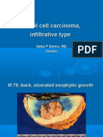  Basal Cell Carcinoma, Infiltrative Type